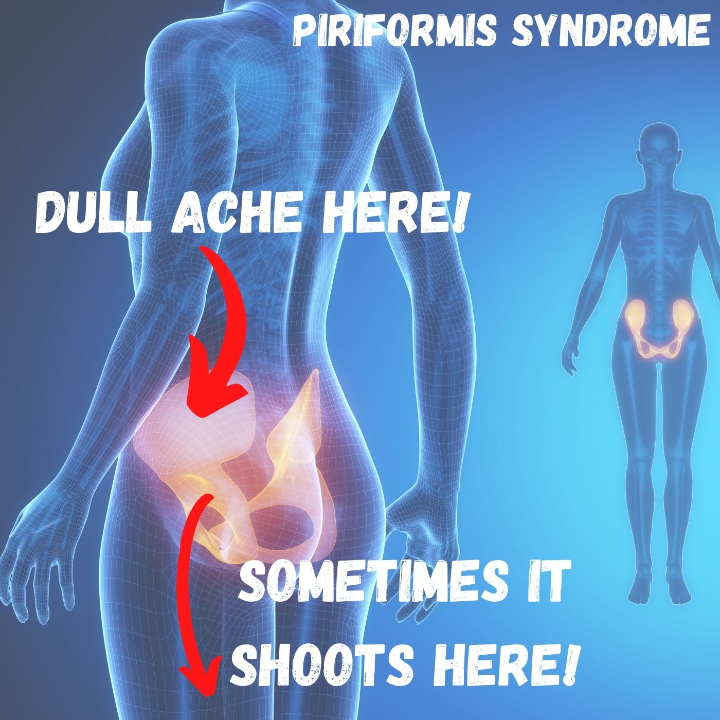 What is the end and long-lasting relief of piriformis syndrome
